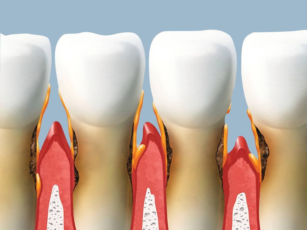 一辈子不洗牙的危害,一辈子不洗牙会有什么后果