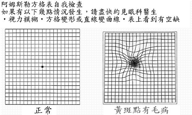 黄斑裂孔怎么治疗,黄斑出血和黄斑裂孔的区别