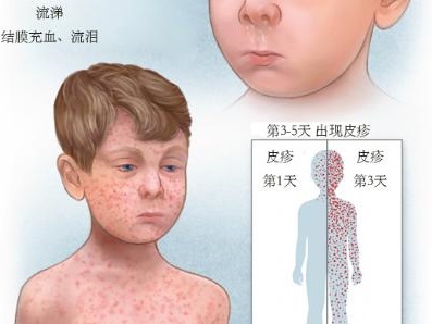 小儿出疹性疾病鉴别,小儿常见出疹性疾病的表现和护理