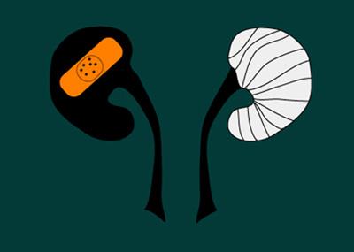 肾癌在多吉美和索坦耐药后可以选择阿昔替尼，但要注意用药风险