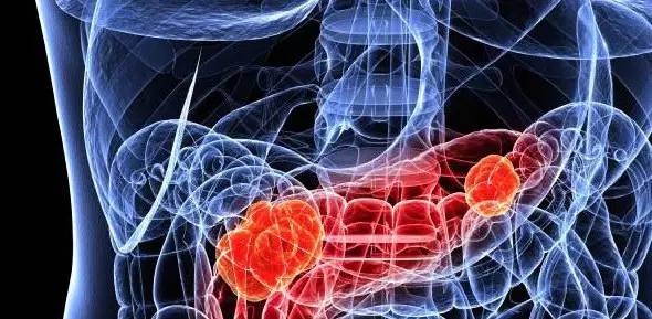 澳洲癌症治愈率,澳洲癌症治疗