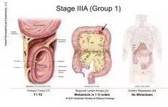 得了直肠癌怎么知道,你了解结直肠癌吗