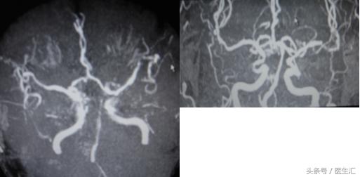 脑溶栓治疗一般多少钱,溶栓治疗需要多少费用