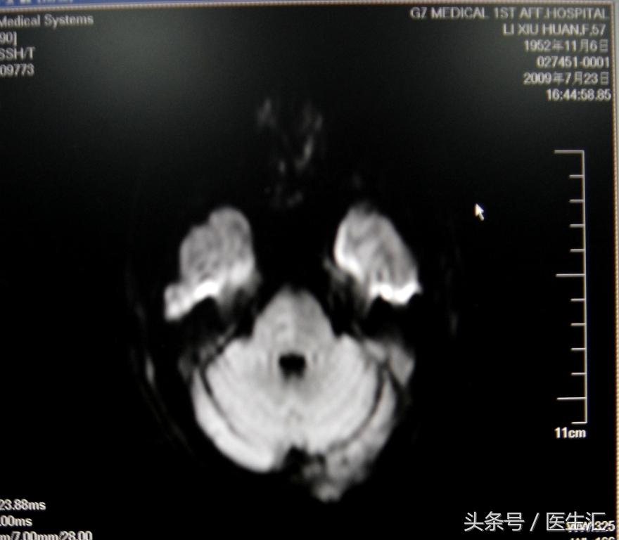 脑溶栓治疗一般多少钱,溶栓治疗需要多少费用