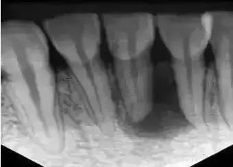 关于牙齿你不知道的小问题,牙齿根管治疗的正确方法