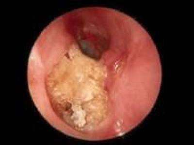耳科常见疾病及治疗措施大全(友谊医院版)