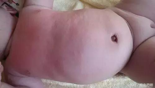 愁人的*麻疹荨**,下次带娃去医院之前一定要看看