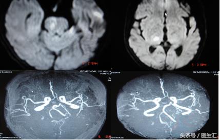 脑溶栓治疗一般多少钱,溶栓治疗需要多少费用