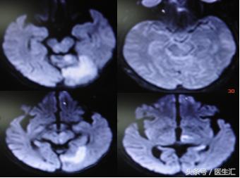脑溶栓治疗一般多少钱,溶栓治疗需要多少费用