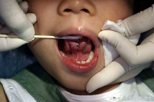 小孩舌头能伸出来是舌系带短吗,舌系带短孩子平翘舌不分怎么办