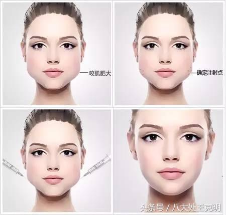 肉毒素咬肌可以完全消除吗,肉毒素能改善咬肌肥大吗