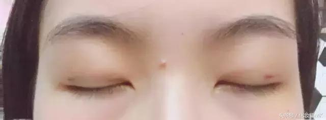 真实贴双眼皮贴,单眼皮怎么贴第二天变双眼皮