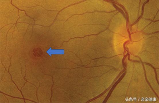 黄斑裂孔怎么治疗,黄斑出血和黄斑裂孔的区别