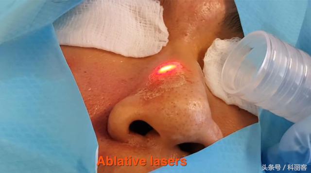 改善毛孔粗大最简单有效的方法,如何有效改善毛孔粗大的方法