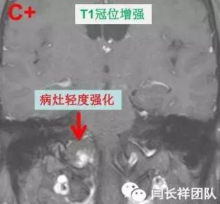 舌头突然不利索,舌头突然间不好使一会就好了