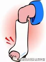 得了脉管炎可以吃韭菜吗,脉管炎怎么解决