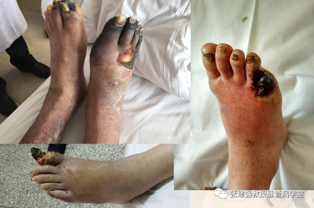 得了脉管炎可以吃韭菜吗,脉管炎怎么解决