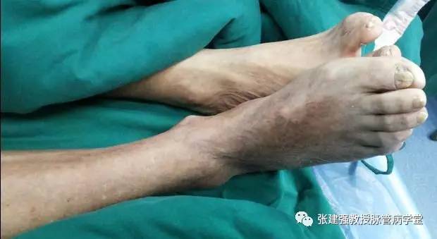 得了脉管炎可以吃韭菜吗,脉管炎怎么解决