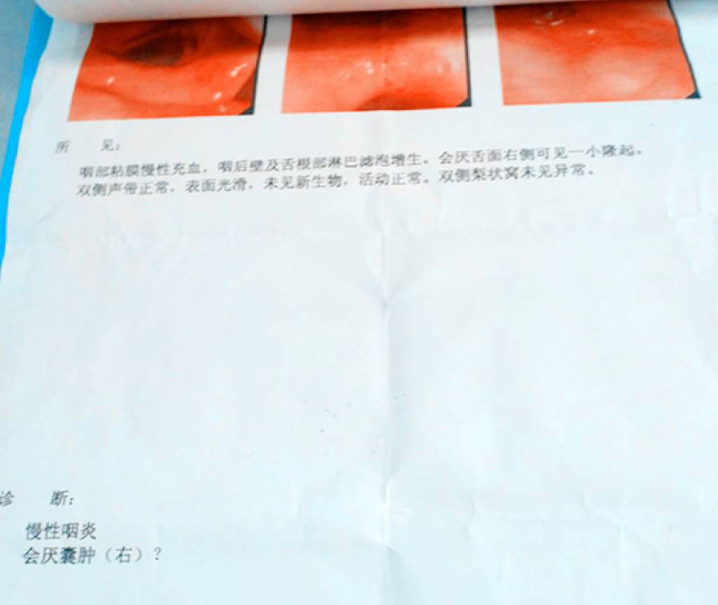 完全性左束支传导阻滞可以治愈吗,完全性左束支传导阻滞能否治愈