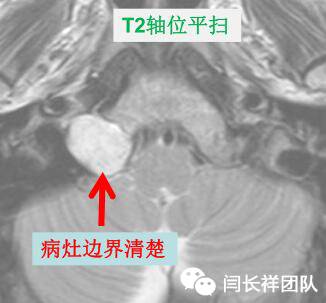 舌头突然不利索,舌头突然间不好使一会就好了