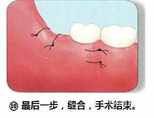 智齿横着长没露出来,智齿牙横着长怎么办