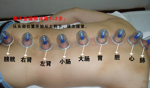 拔罐后注意事项与禁忌,你知道拔火罐用什么罐吗