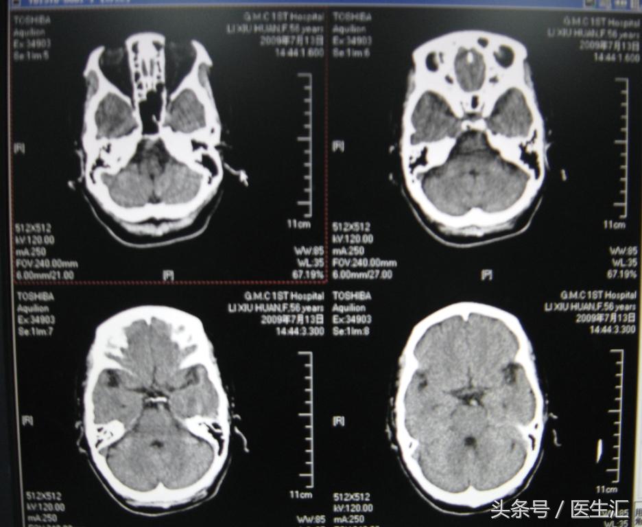 脑溶栓治疗一般多少钱,溶栓治疗需要多少费用