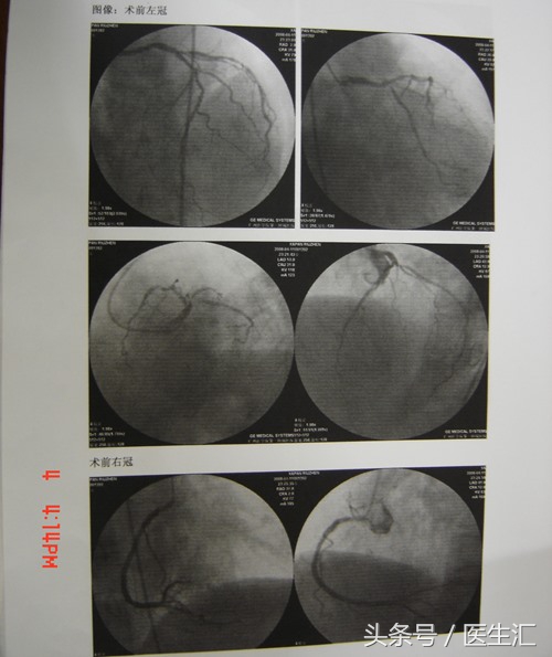 脑溶栓治疗一般多少钱,溶栓治疗需要多少费用