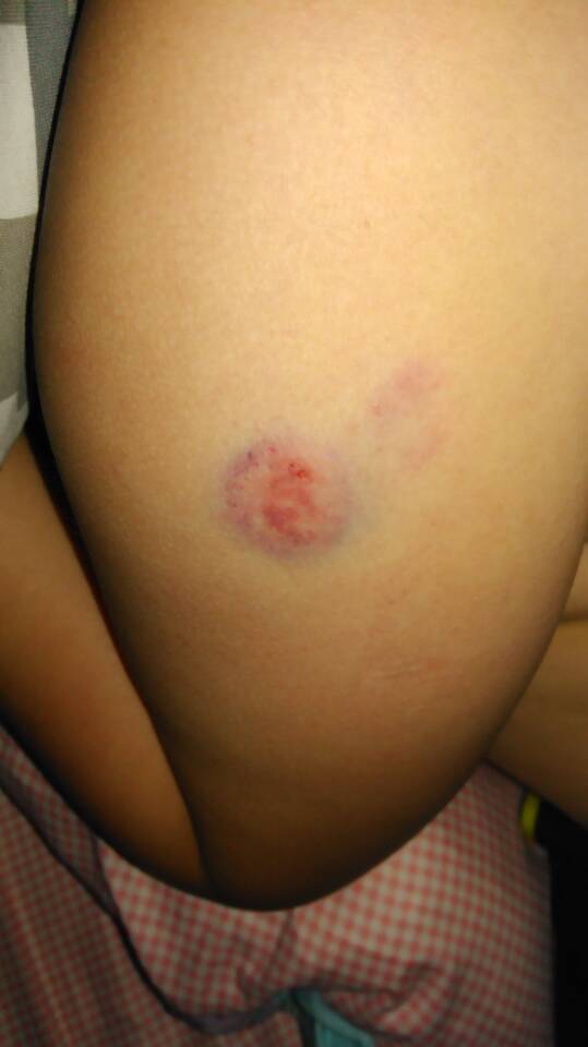 孩子在学校被同学咬了该怎么处理,女儿在幼儿园被同学咬了怎么处理