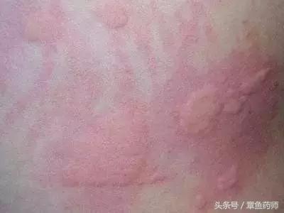 愁人的*麻疹荨**,下次带娃去医院之前一定要看看