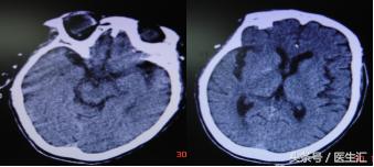 脑溶栓治疗一般多少钱,溶栓治疗需要多少费用