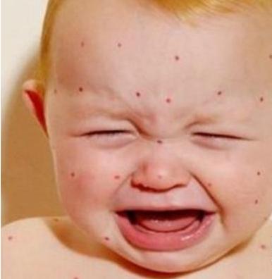 宝宝皮肤过敏了怎么办才好,宝宝皮肤过敏怎么办才好