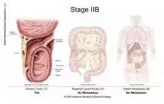 得了直肠癌怎么知道,你了解结直肠癌吗