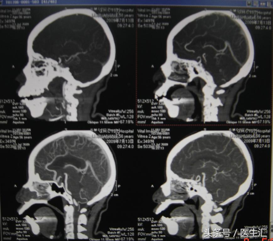 脑溶栓治疗一般多少钱,溶栓治疗需要多少费用