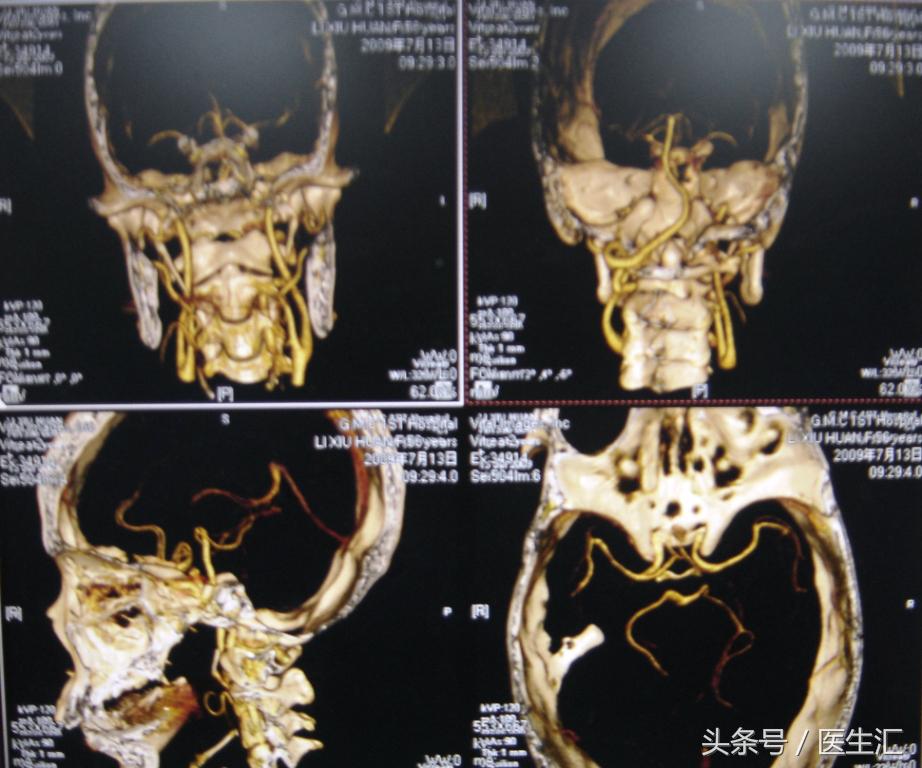 脑溶栓治疗一般多少钱,溶栓治疗需要多少费用