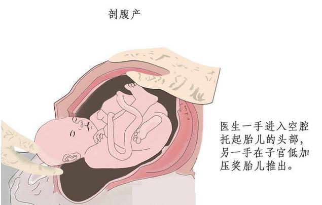 选择剖腹产还是顺产的后悔,准妈妈们慎重选择剖腹产