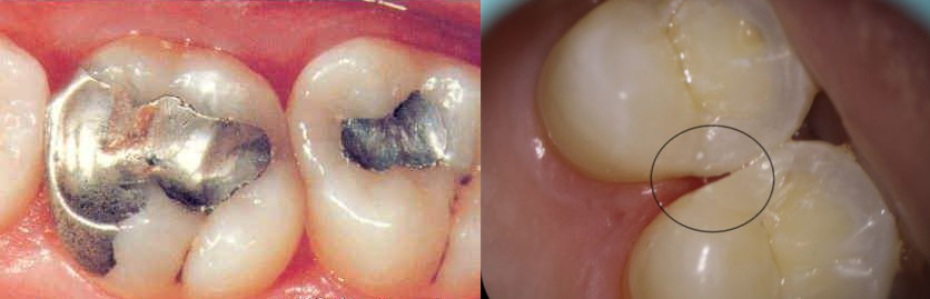 补牙后边缘皮肤变黑怎么回事,门牙树脂补牙后变黑怎样变白