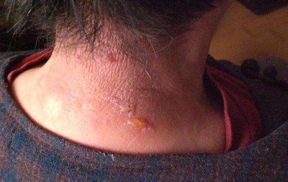 艾灸过敏发红发痒涂烫伤膏管用吗,艾灸肚脐每次都皮肤过敏怎么办