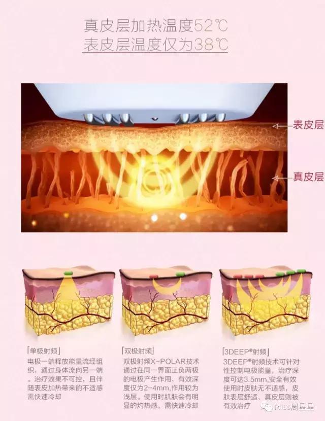 射频美容仪中的LV和香奈儿,Stop和NEWA选哪个?