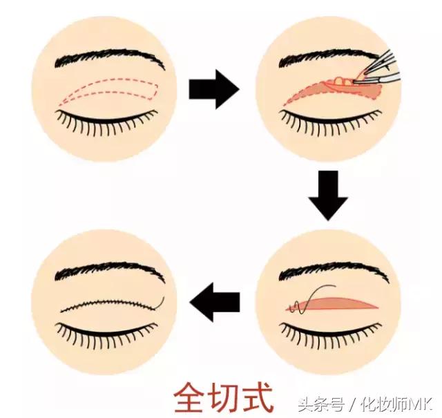 真实贴双眼皮贴,单眼皮怎么贴第二天变双眼皮