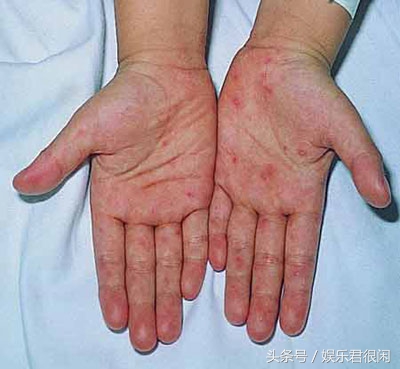 手足口病并不可怕,手足口病刚发现就治疗几天会好
