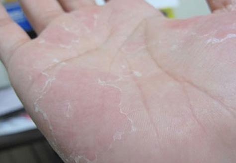 手脚脱皮是什么原因造成的,如何处理才好?