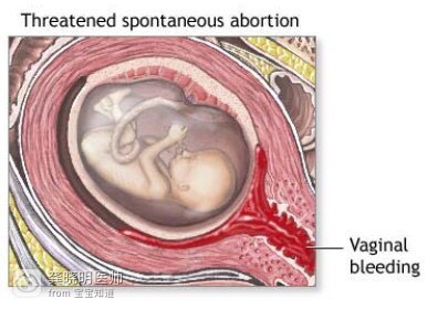 早孕发现出血了该怎么办,医学博士科普怀孕