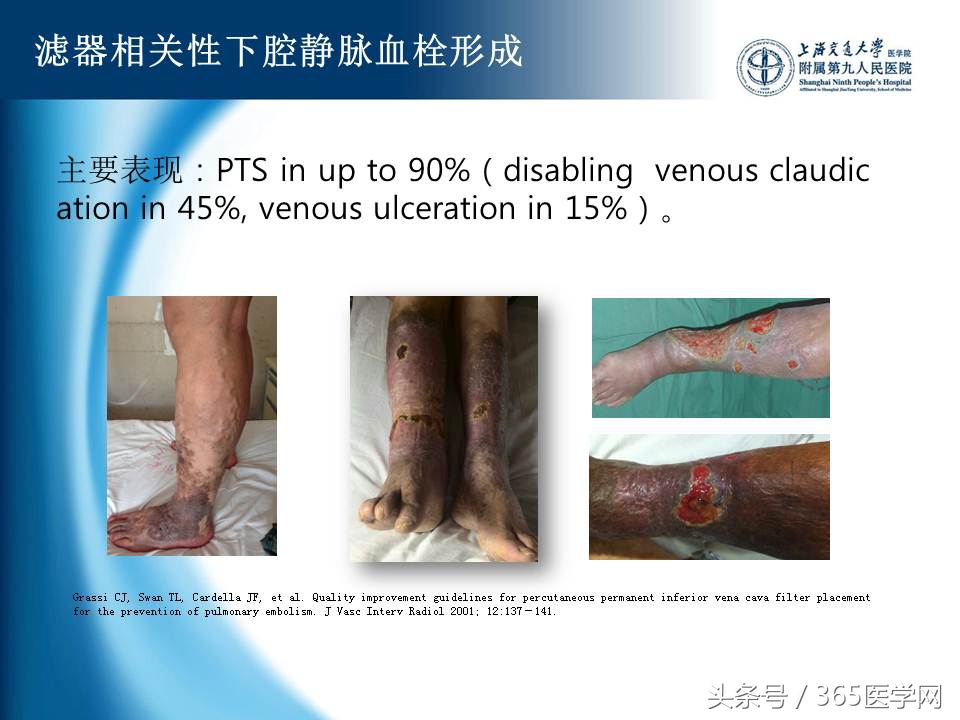 下肢静脉血栓植入滤器后的护理,下肢静脉血栓滤器植入后注意事项