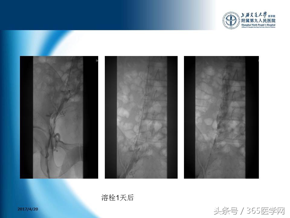 下肢静脉血栓植入滤器后的护理,下肢静脉血栓滤器植入后注意事项