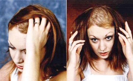 拔毛癖长头发,拔毛癖会拔别人的头发么