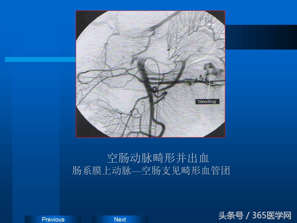 崔进国：消化道出血的介入治疗