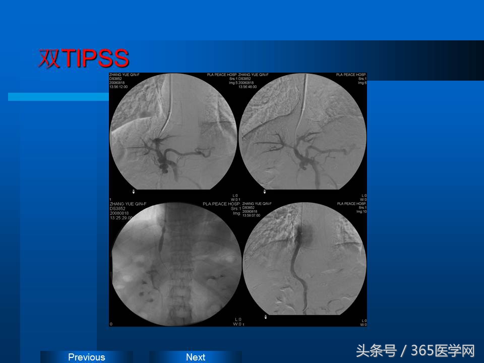 崔进国：消化道出血的介入治疗