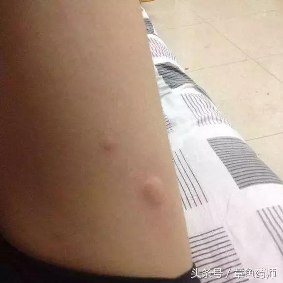 愁人的*麻疹荨**,下次带娃去医院之前一定要看看