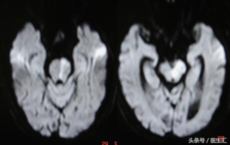 脑溶栓治疗一般多少钱,溶栓治疗需要多少费用